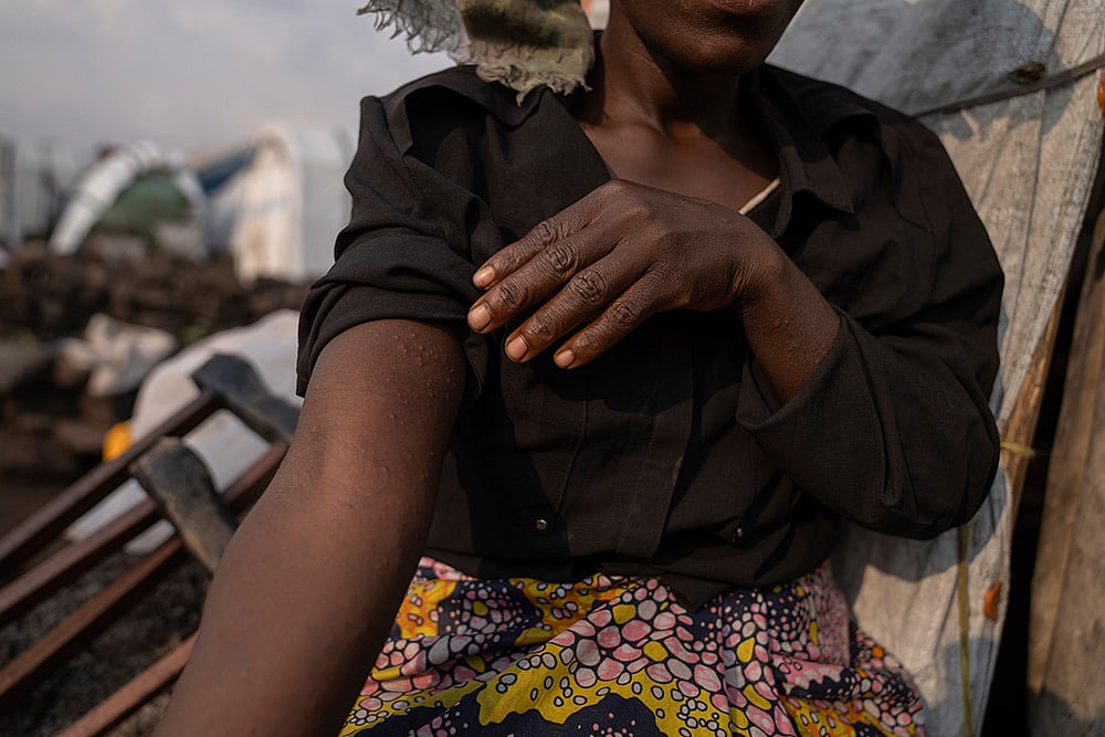 | Photo: AP/Moses Sawasawa : Congo Mpox: Sarah Bagheni, a suspected patient, in the Bulengo refugee camp in Goma.